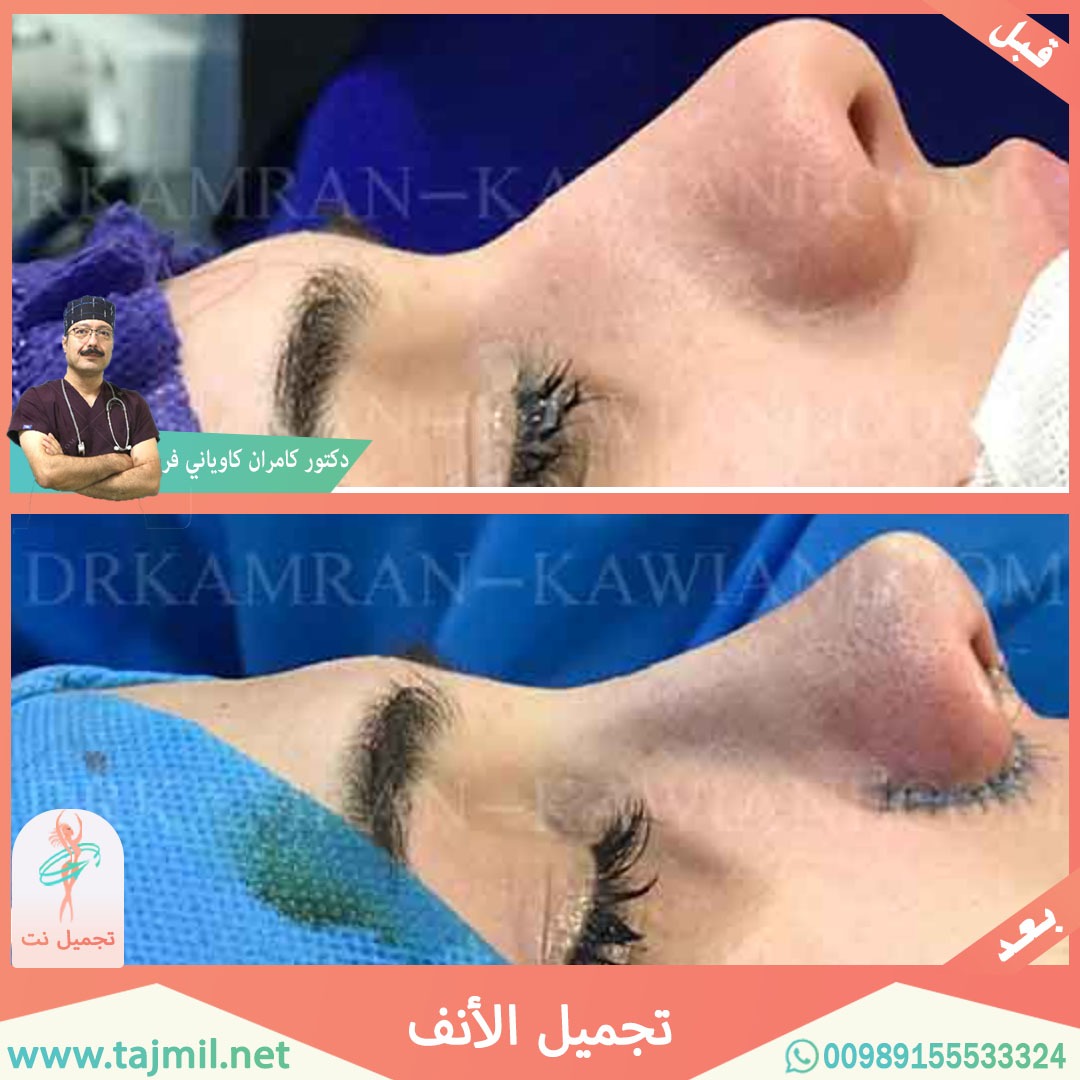  - دکتور کامران کاویاني فرعملية تجميل الانف في ايران مع تجميل نت