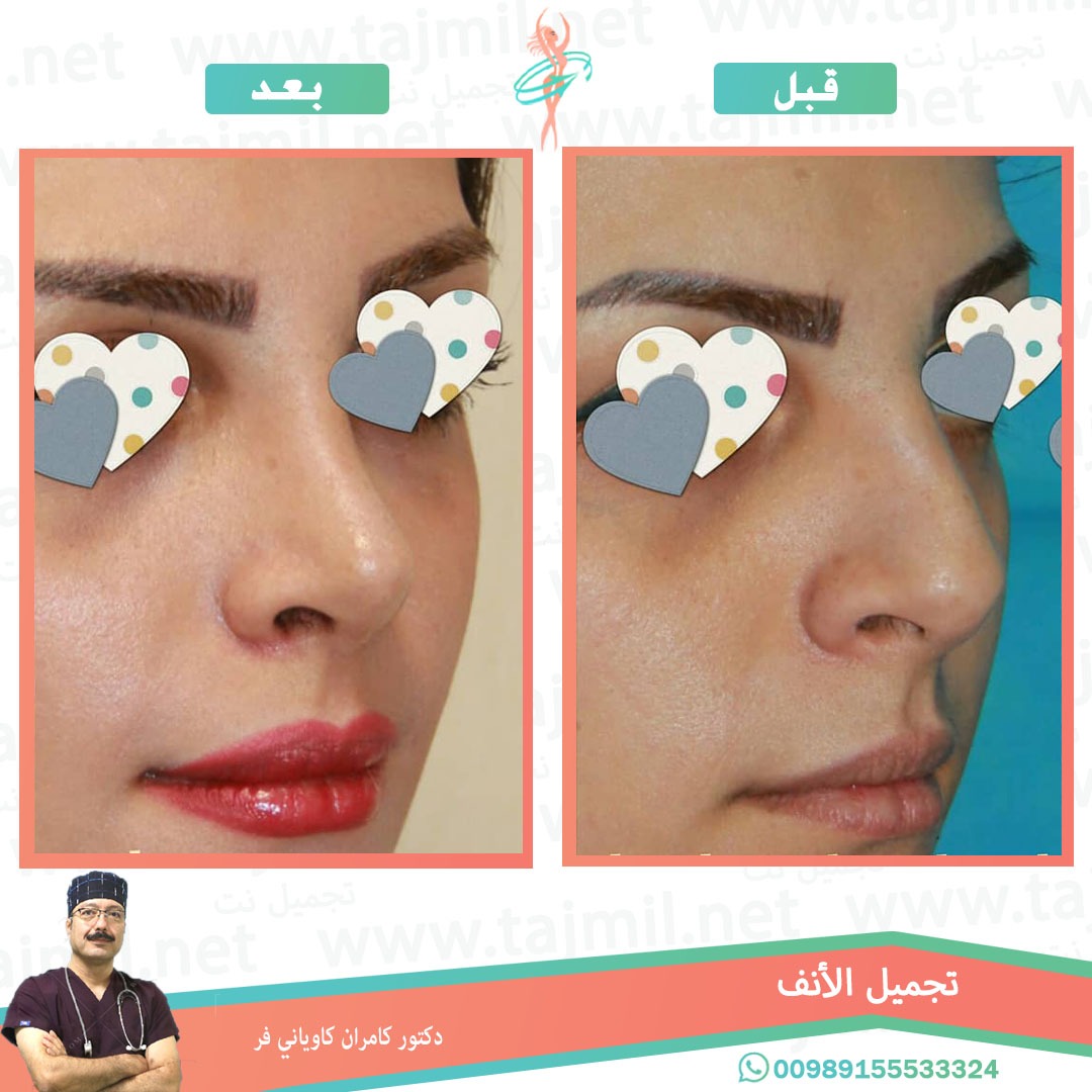  - دکتور کامران کاویاني فرعملية تجميل الانف في ايران مع تجميل نت