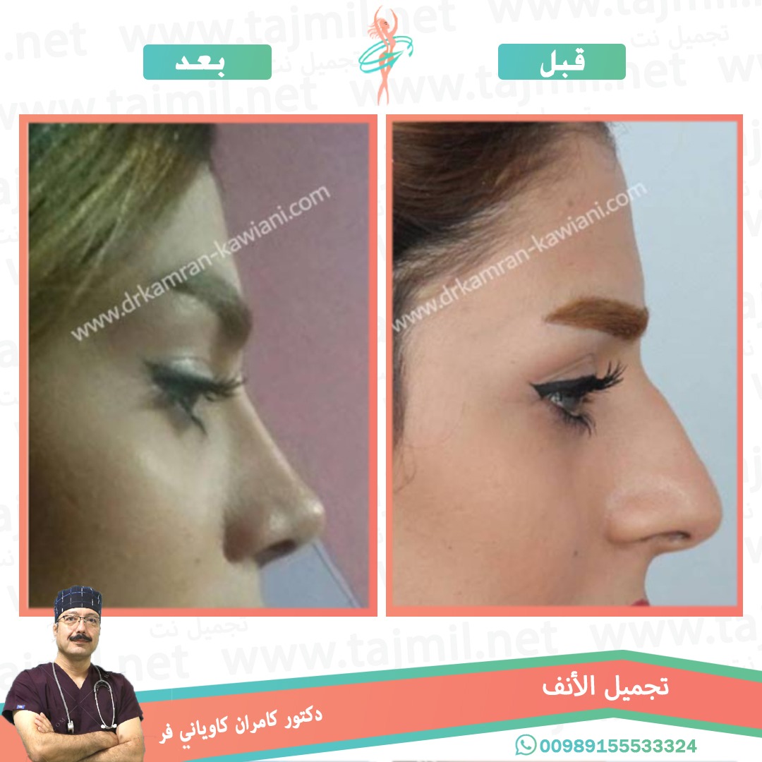  - دکتور کامران کاویاني فرعملية تجميل الانف في ايران مع تجميل نت