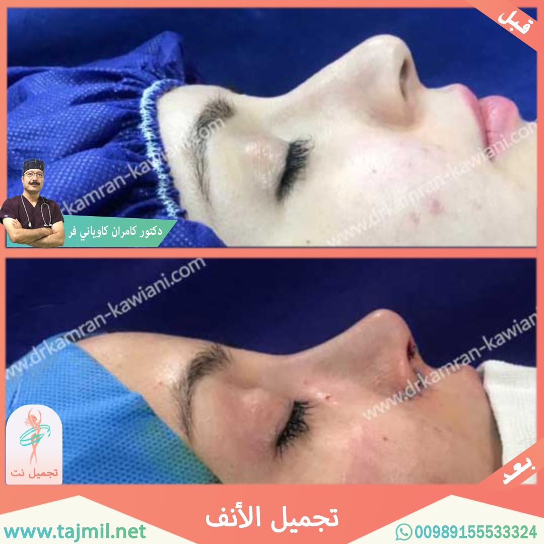  - دکتور کامران کاویاني فرعملية تجميل الانف في ايران مع تجميل نت