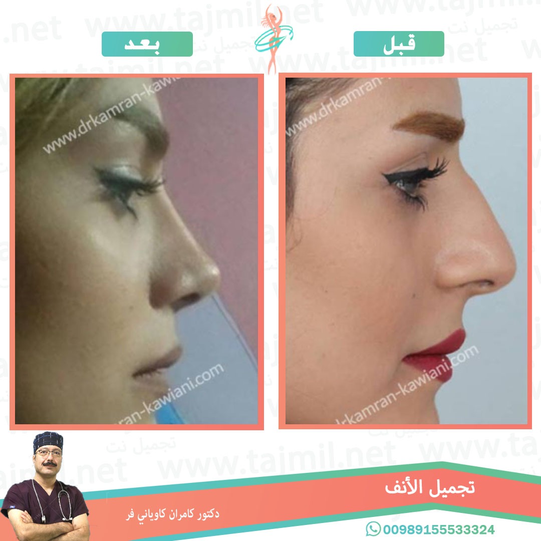  - دکتور کامران کاویاني فرعملية تجميل الانف في ايران مع تجميل نت