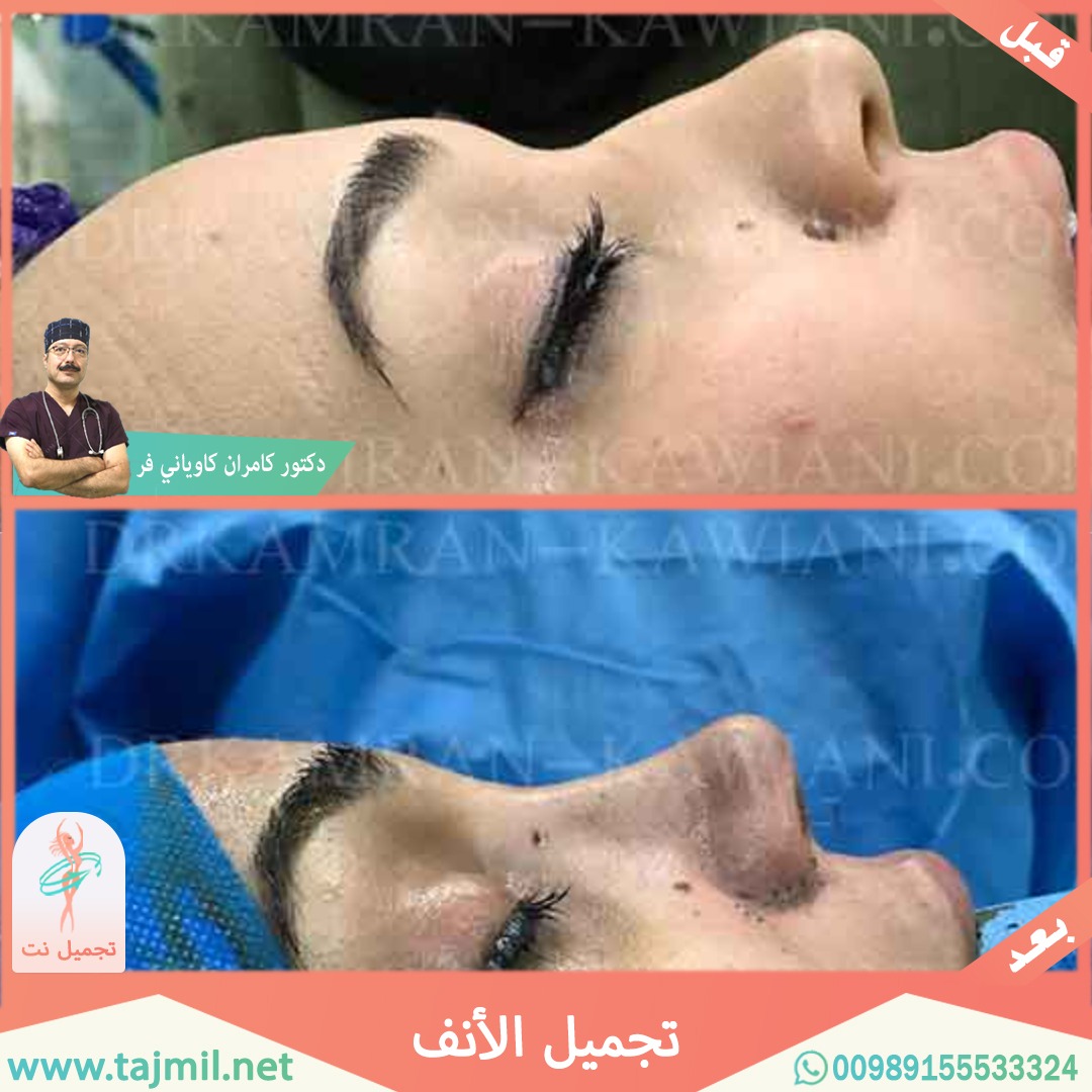  - دکتور کامران کاویاني فرعملية تجميل الانف في ايران مع تجميل نت