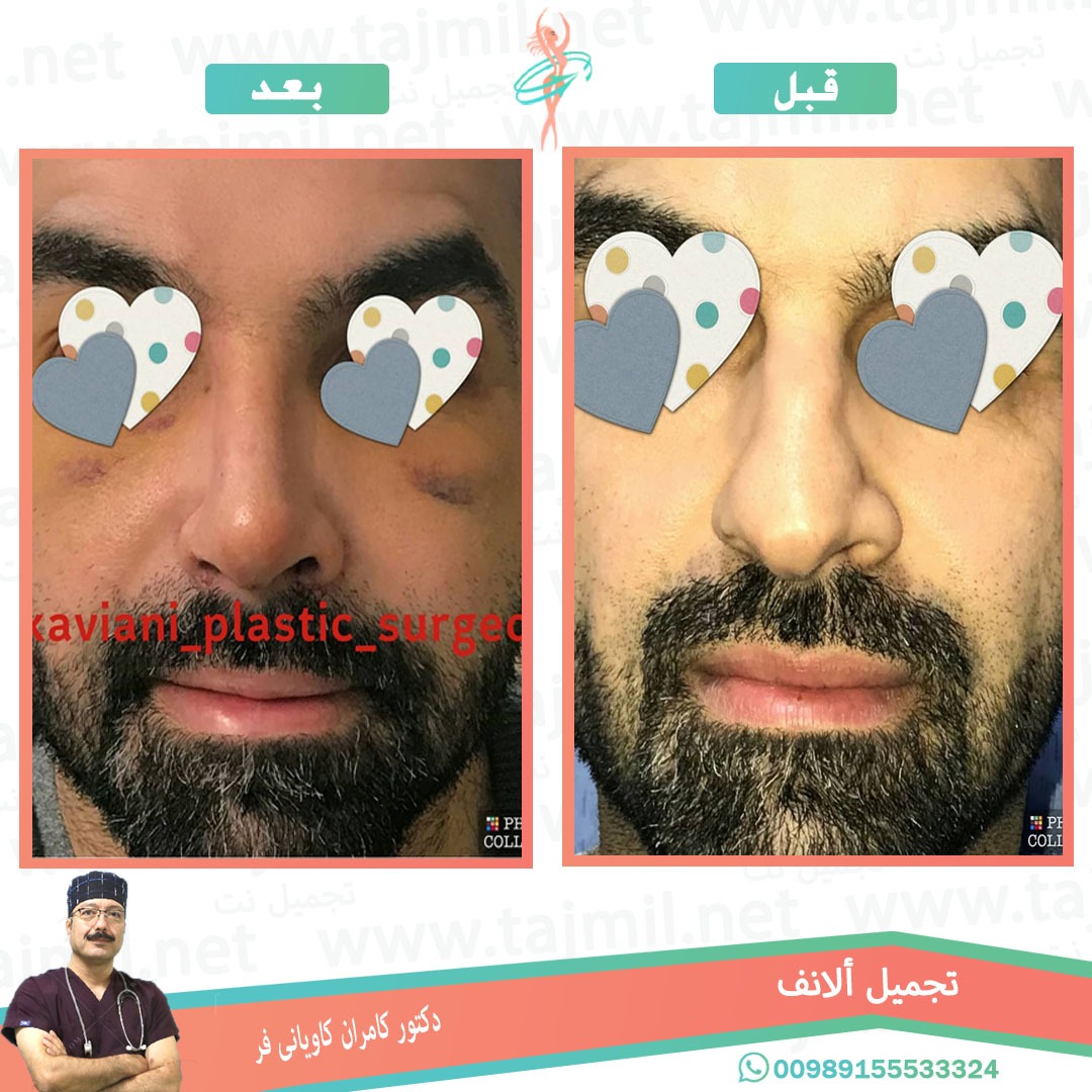  - دکتور کامران کاویاني فرعملية تجميل الانف في ايران مع تجميل نت