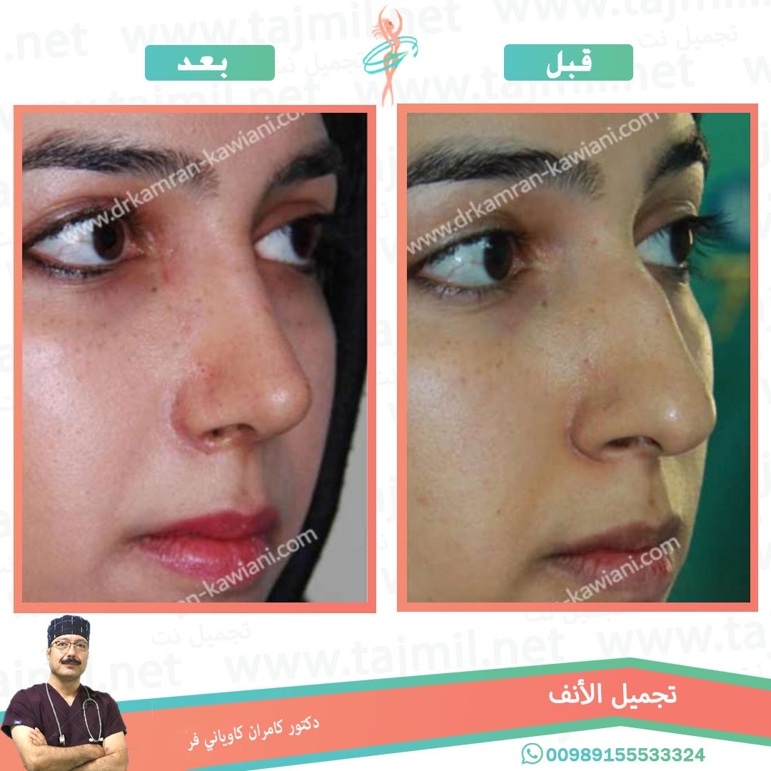  - دکتور کامران کاویاني فرعملية تجميل الانف في ايران مع تجميل نت