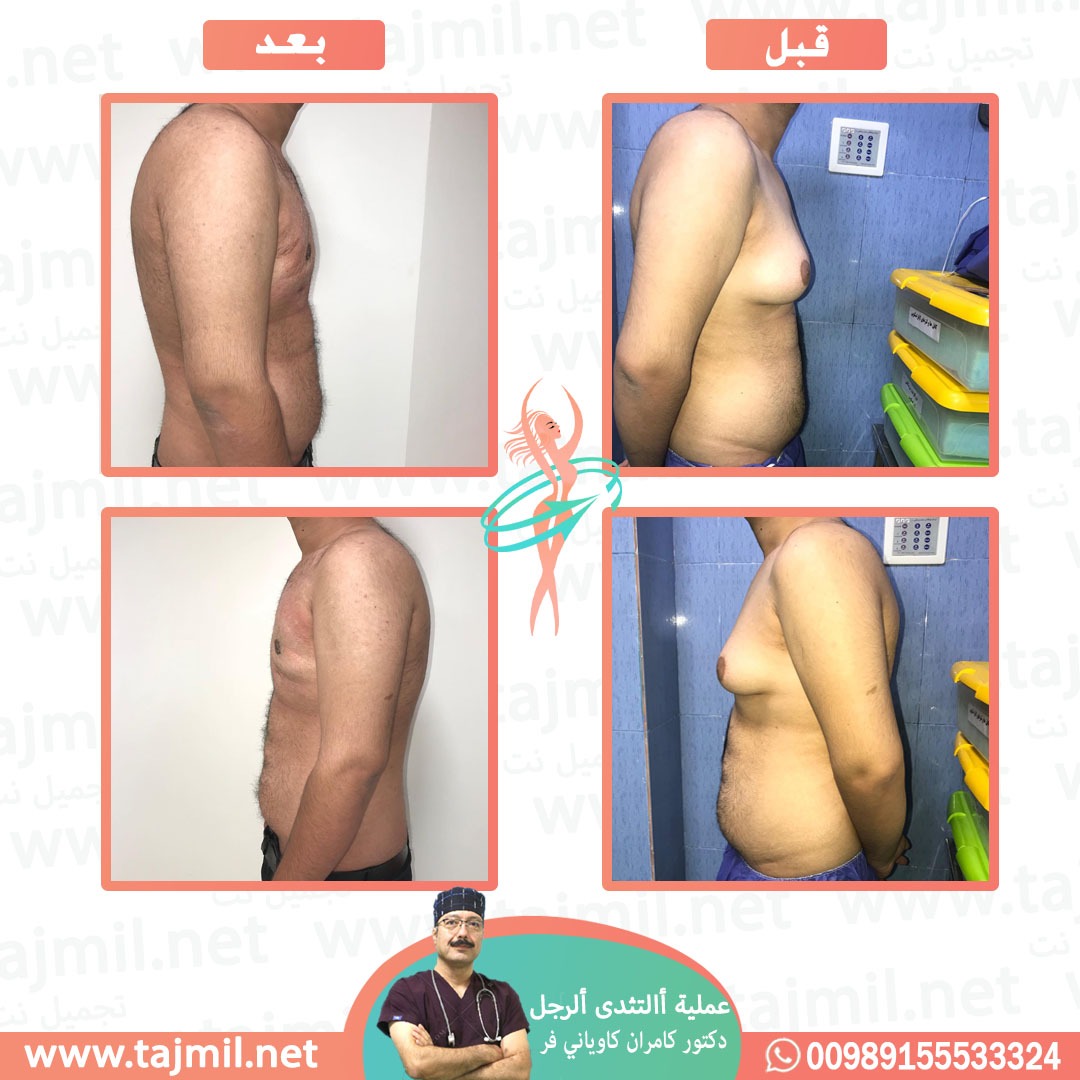  - دکتور کامران کاویاني فرعملية ألتثدی ألرجل في ايران مع تجميل نت