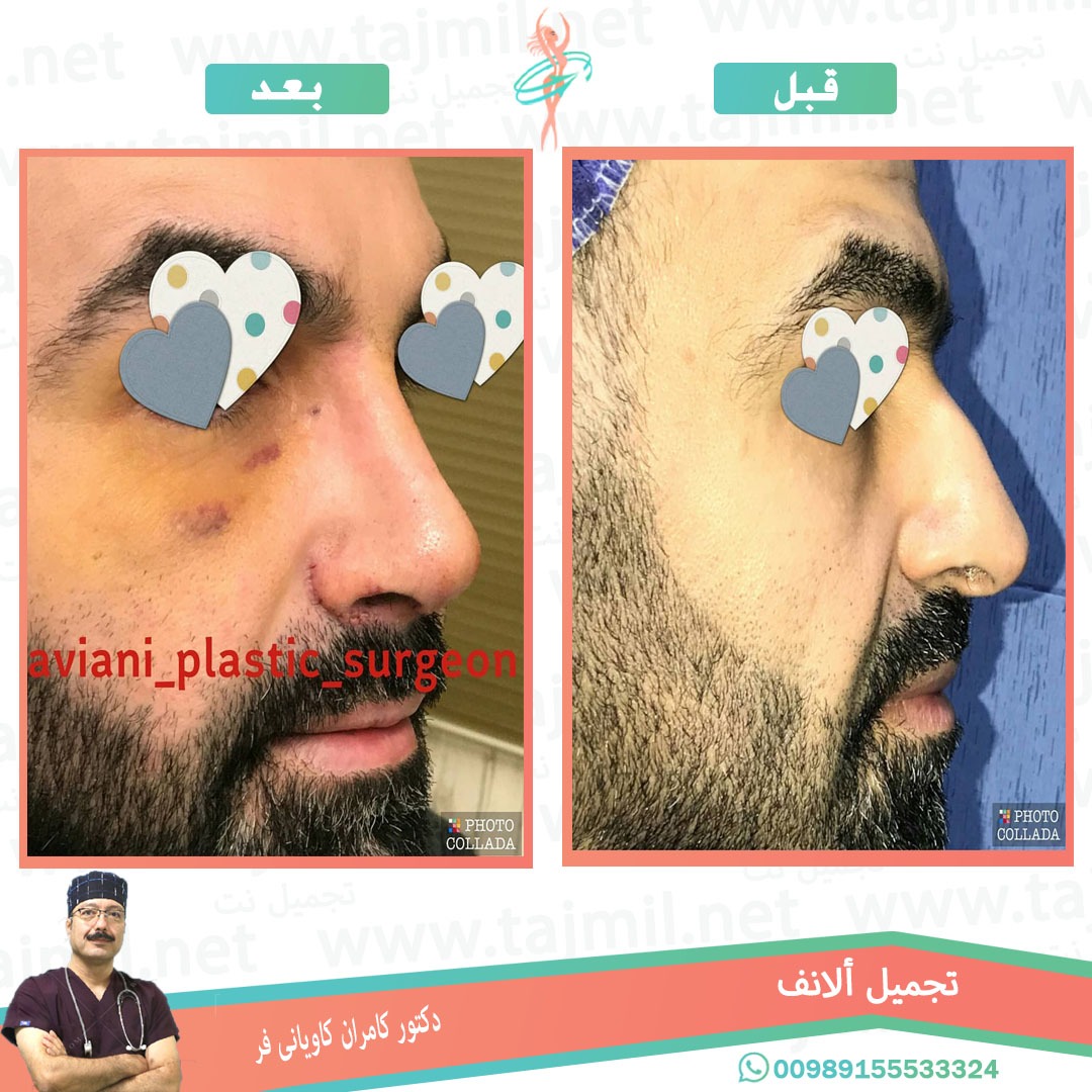  - دکتور کامران کاویاني فرعملية تجميل الانف في ايران مع تجميل نت