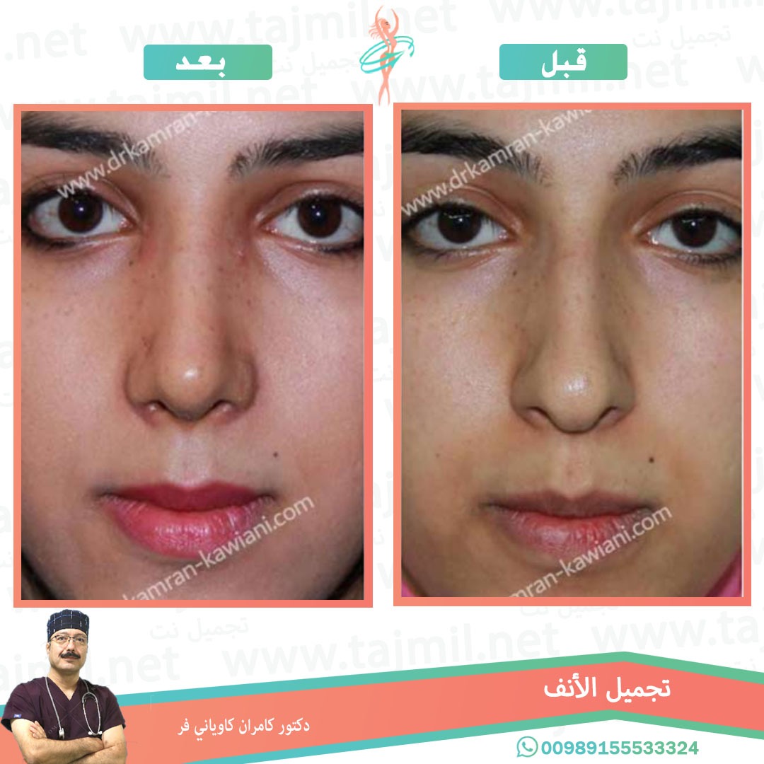  - دکتور کامران کاویاني فرعملية تجميل الانف في ايران مع تجميل نت