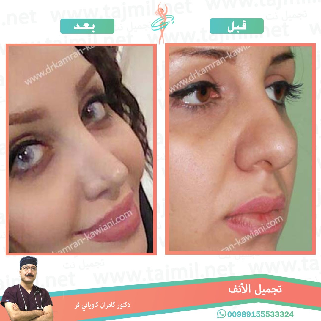  - دکتور کامران کاویاني فرعملية تجميل الانف في ايران مع تجميل نت