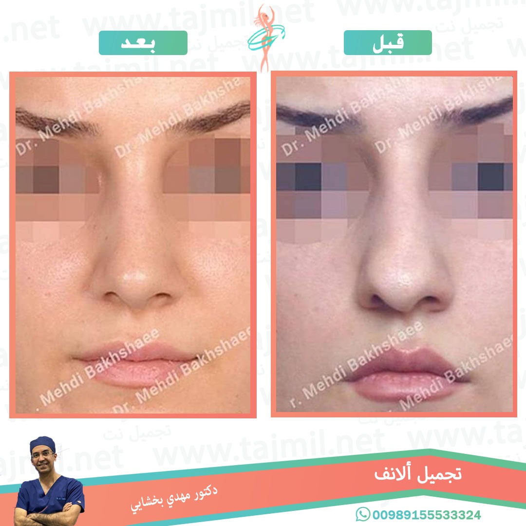  - دکتور مهدي بخشایي عملية تجميل الانف في ايران مع تجميل نت