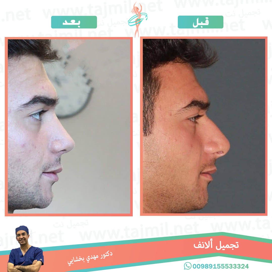  - دکتور مهدي بخشایي عملية تجميل الانف في ايران مع تجميل نت