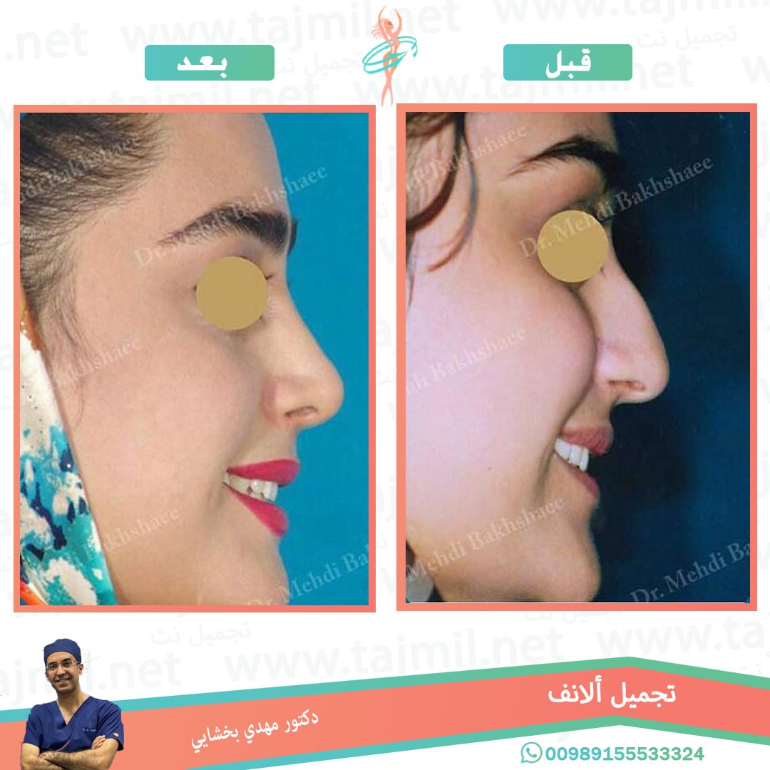  - دکتور مهدي بخشایي عملية تجميل الانف في ايران مع تجميل نت