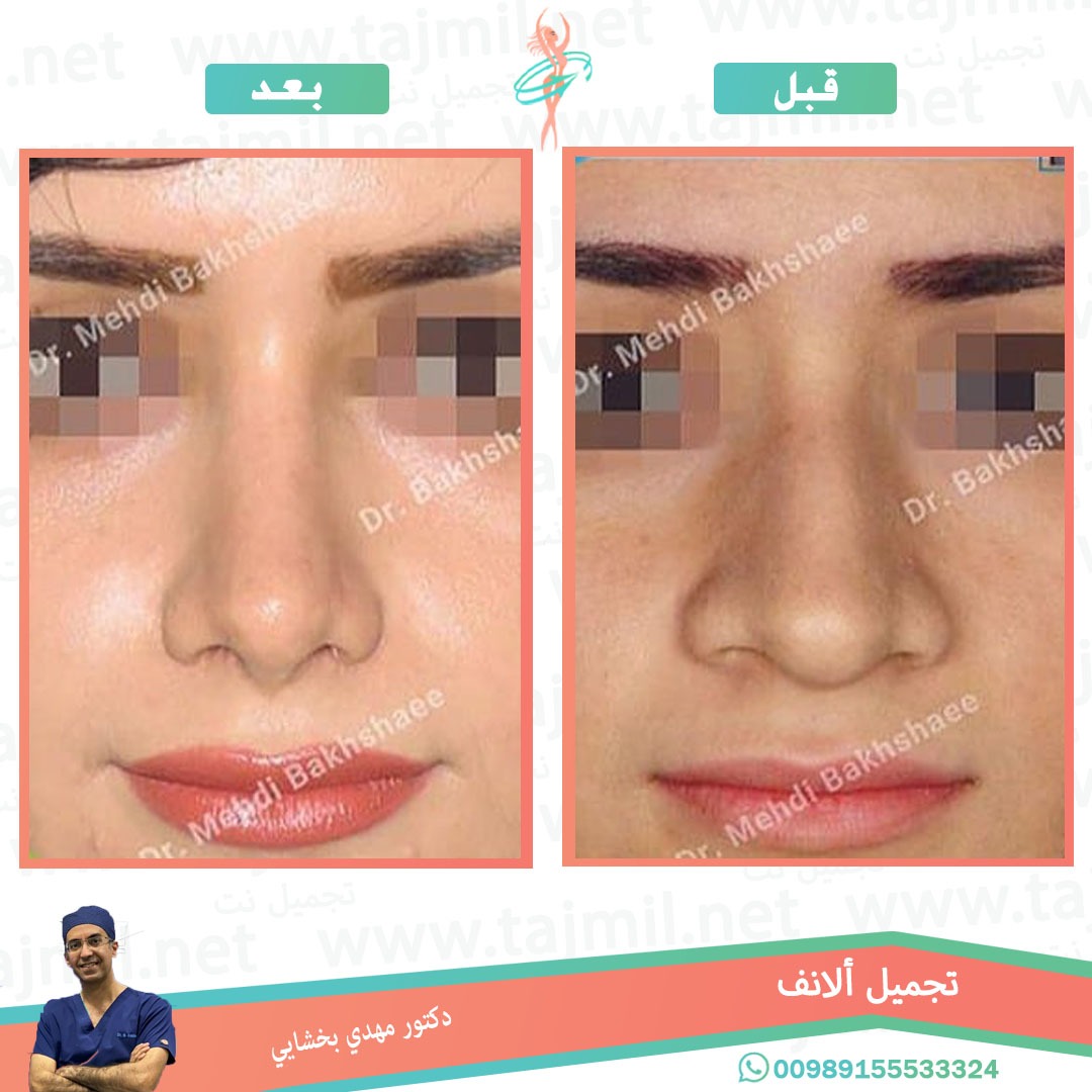  - دکتور مهدي بخشایي عملية تجميل الانف في ايران مع تجميل نت