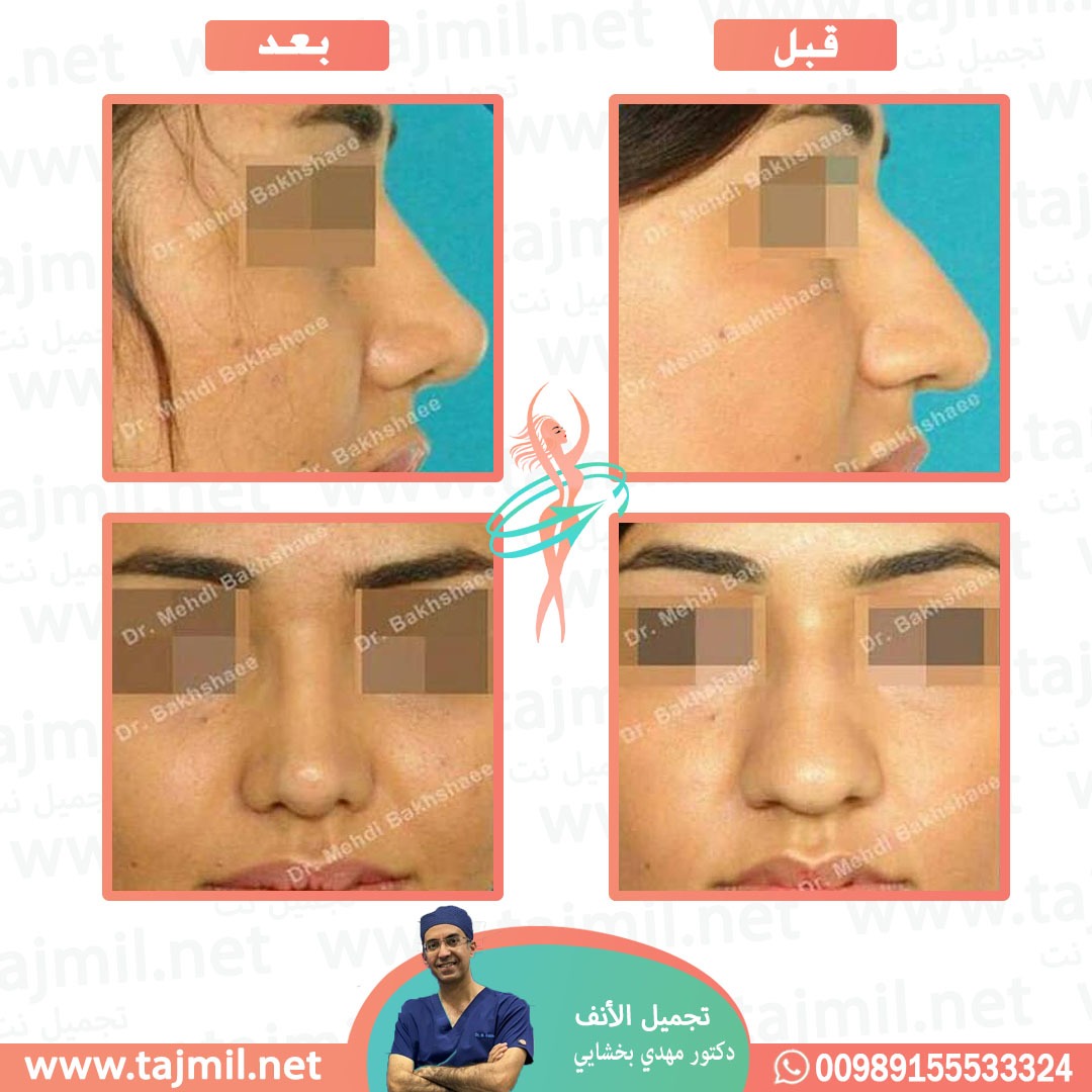  - دکتور مهدي بخشایي عملية تجميل الانف في ايران مع تجميل نت