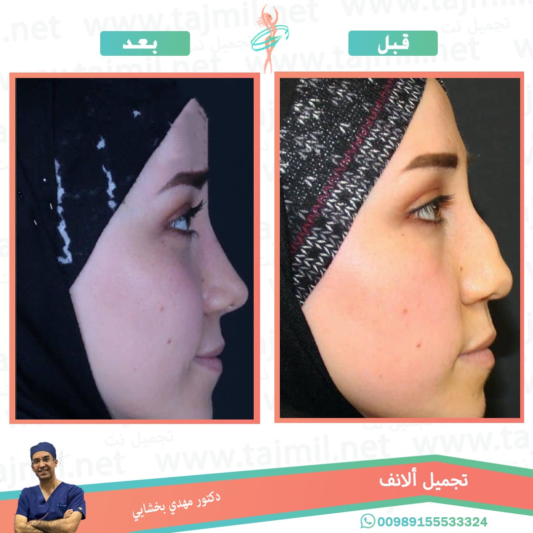  - دکتور مهدي بخشایي عملية تجميل الانف في ايران مع تجميل نت