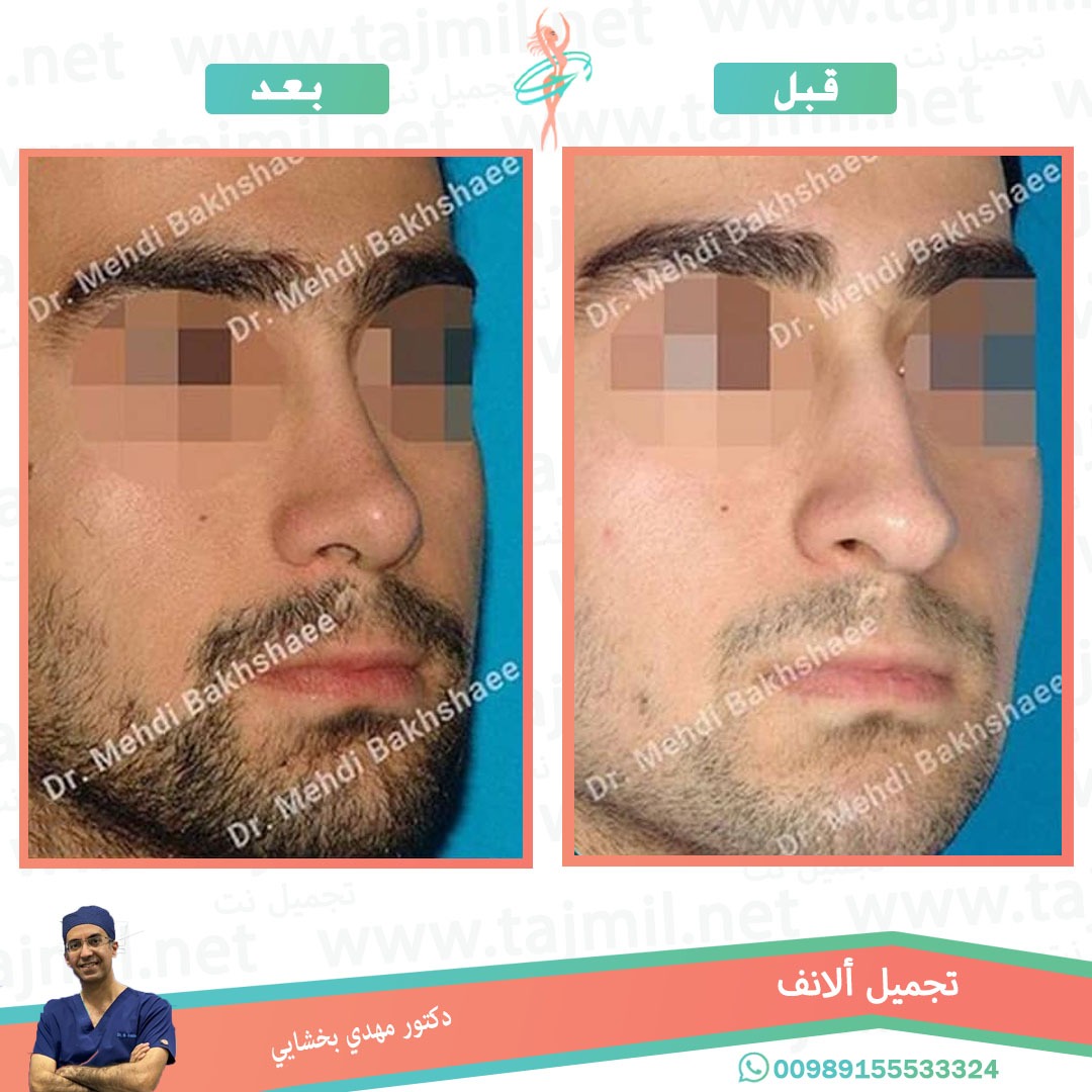  - دکتور مهدي بخشایي عملية تجميل الانف في ايران مع تجميل نت