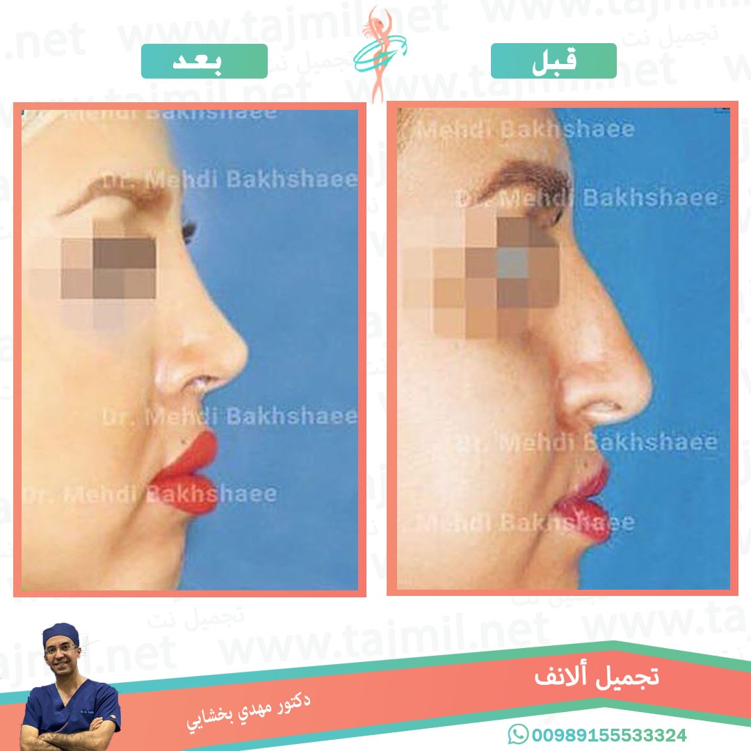  - دکتور مهدي بخشایي عملية تجميل الانف في ايران مع تجميل نت