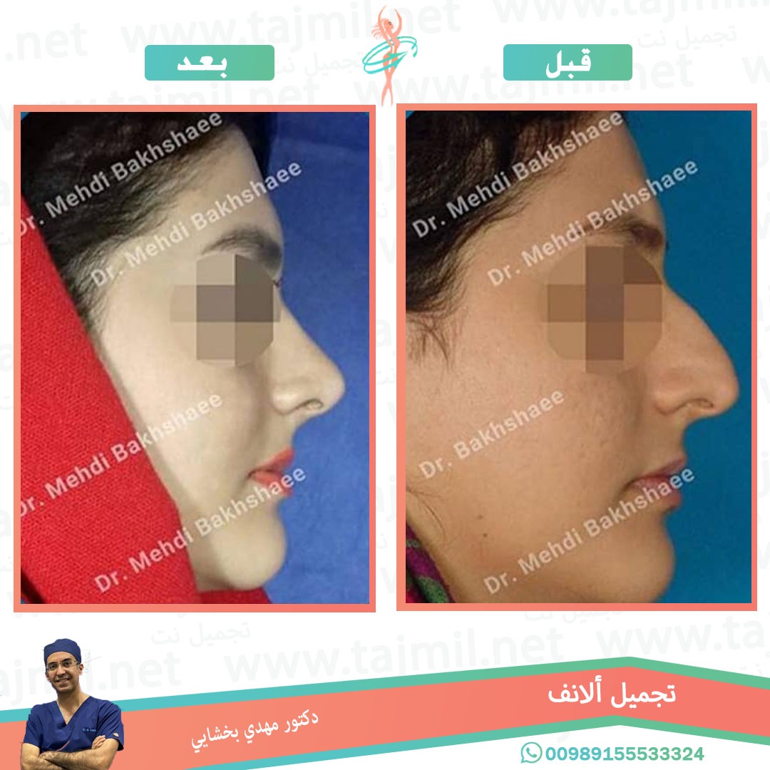  - دکتور مهدي بخشایي عملية تجميل الانف في ايران مع تجميل نت