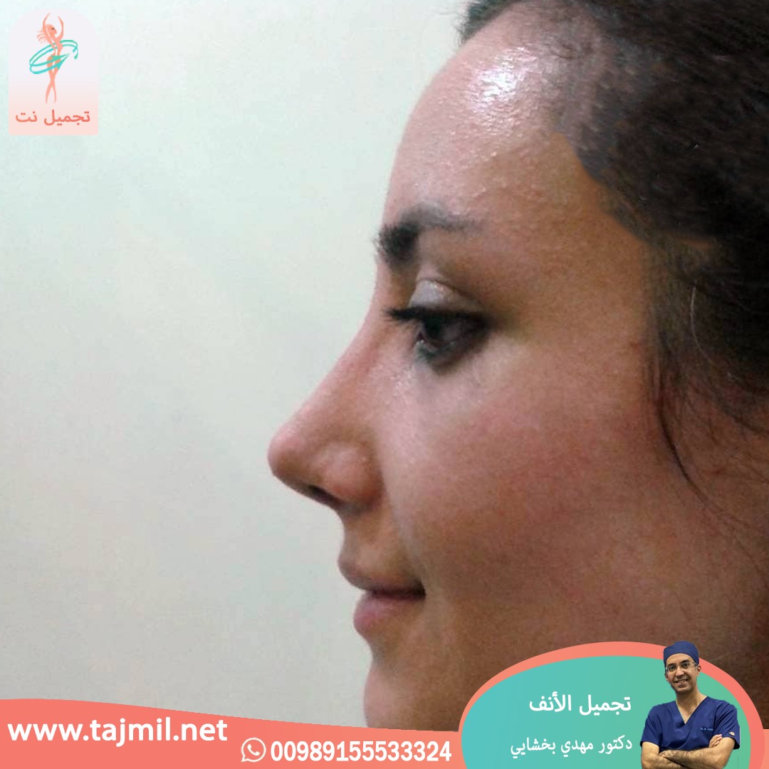  - دکتور مهدي بخشایي عملية تجميل الانف في ايران مع تجميل نت