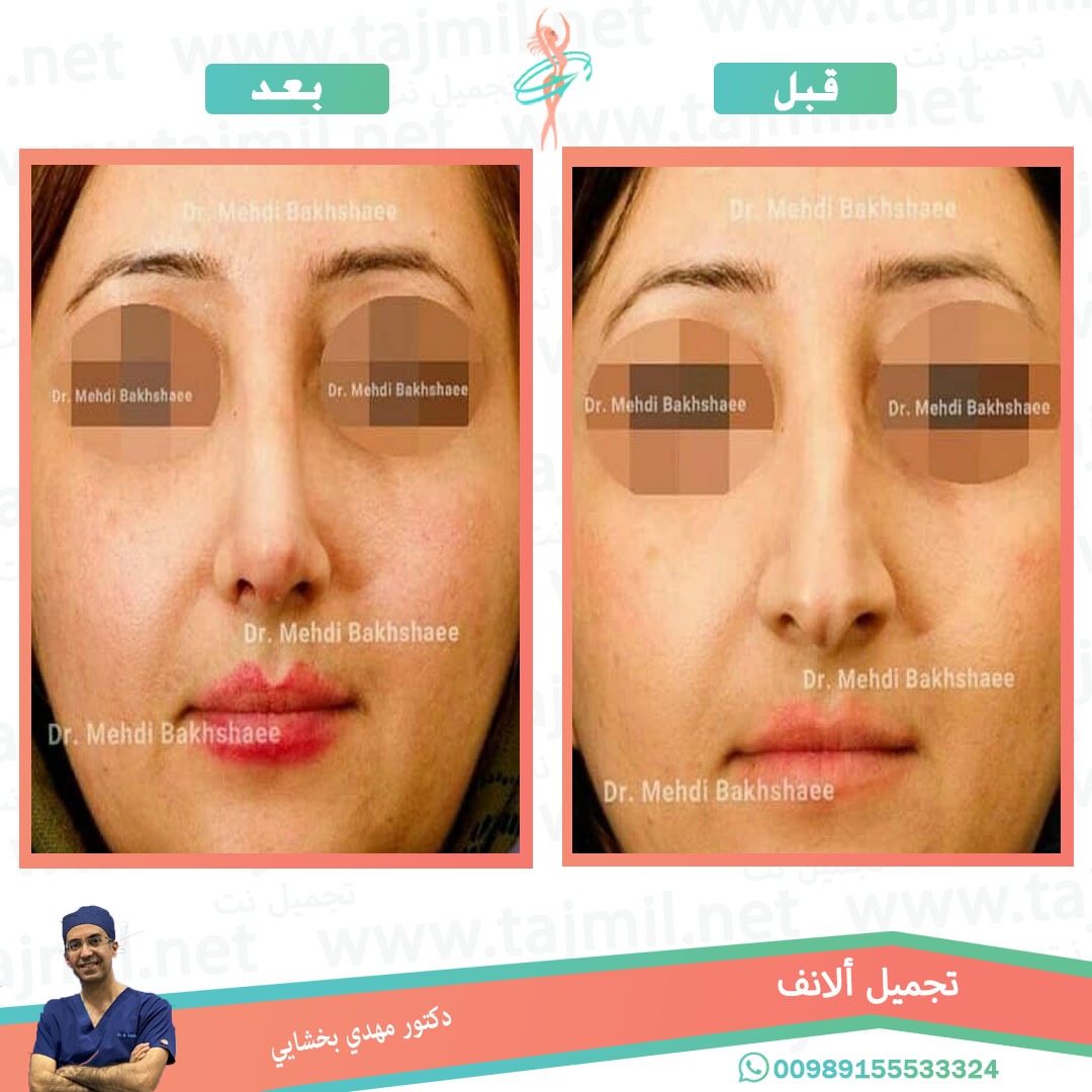  - دکتور مهدي بخشایي عملية تجميل الانف في ايران مع تجميل نت