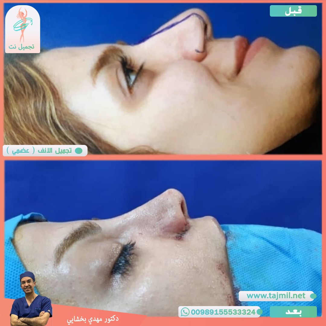  - دکتور مهدي بخشایي عملية تجميل الانف في ايران مع تجميل نت