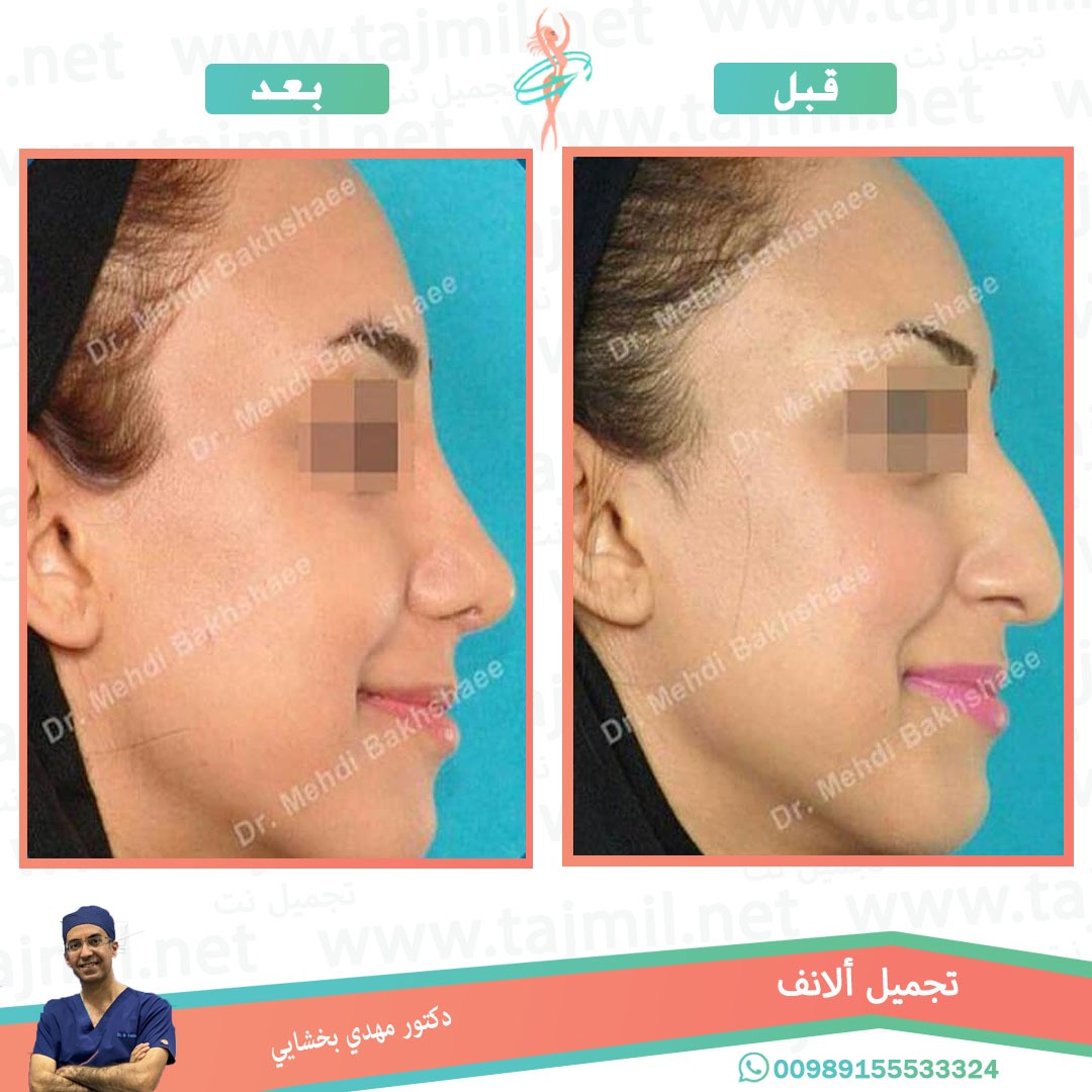  - دکتور مهدي بخشایي عملية تجميل الانف في ايران مع تجميل نت