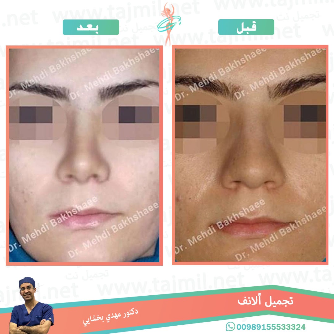  - دکتور مهدي بخشایي عملية تجميل الانف في ايران مع تجميل نت