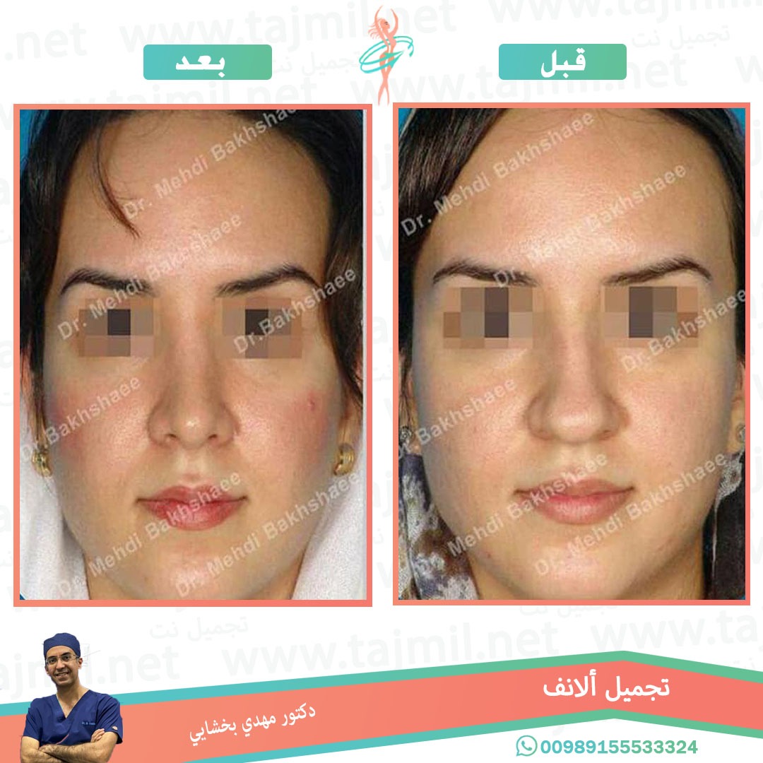  - دکتور مهدي بخشایي عملية تجميل الانف في ايران مع تجميل نت