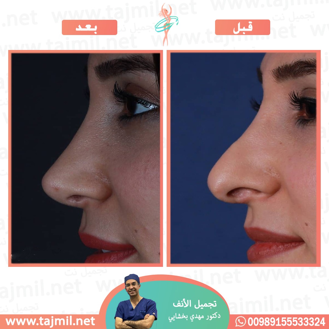  - دکتور مهدي بخشایي عملية تجميل الانف في ايران مع تجميل نت