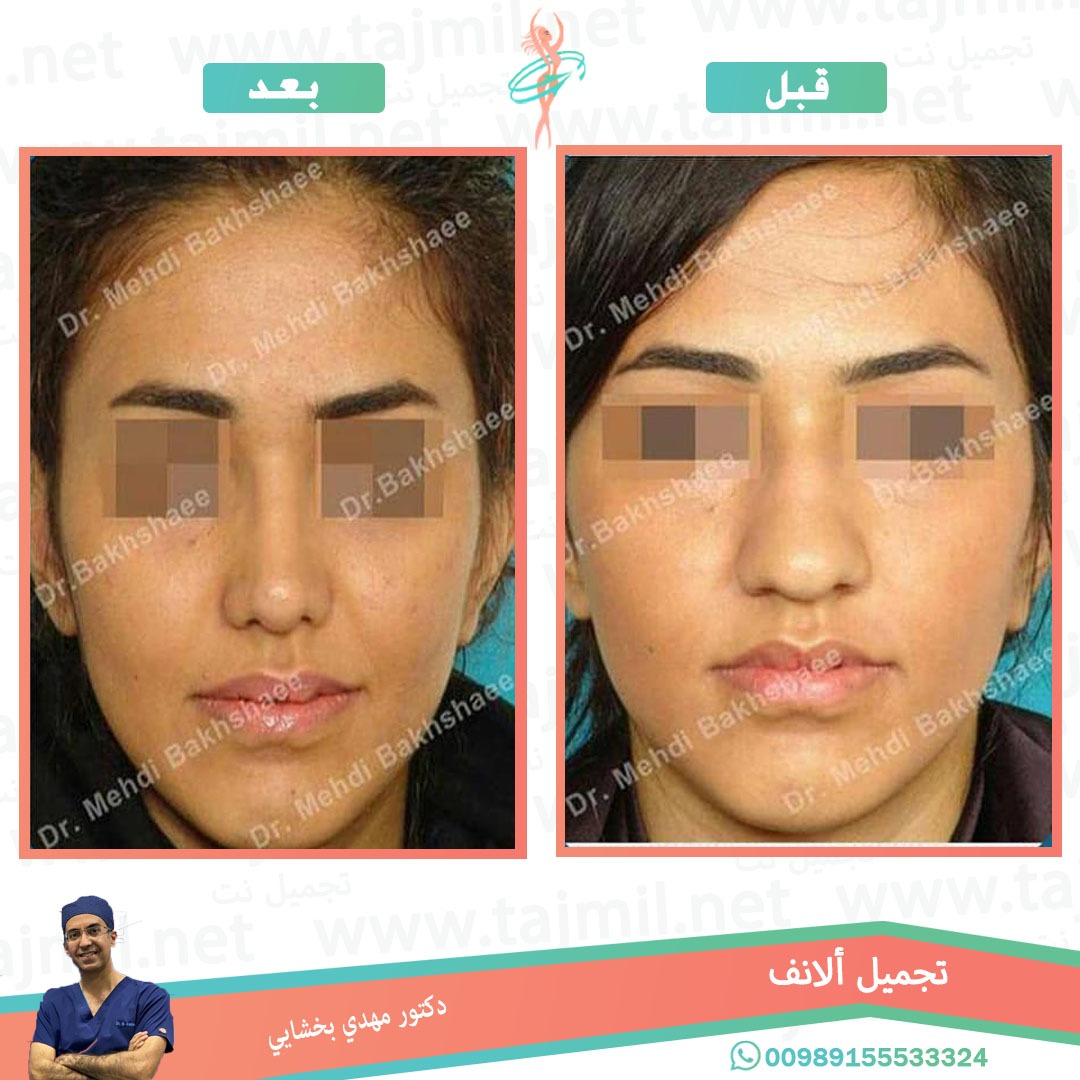  - دکتور مهدي بخشایي عملية تجميل الانف في ايران مع تجميل نت