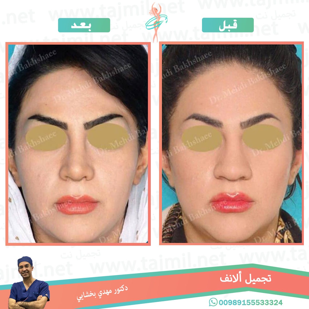  - دکتور مهدي بخشایي عملية تجميل الانف في ايران مع تجميل نت