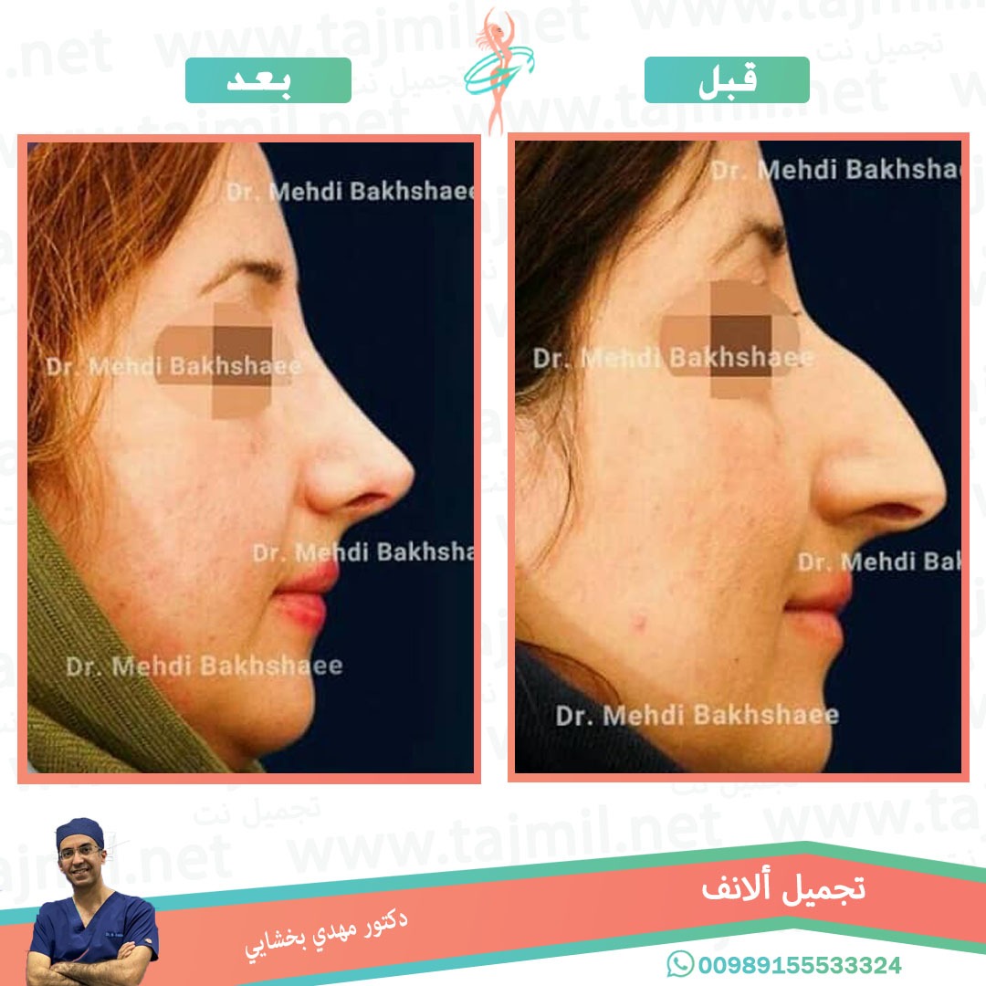  - دکتور مهدي بخشایي عملية تجميل الانف في ايران مع تجميل نت