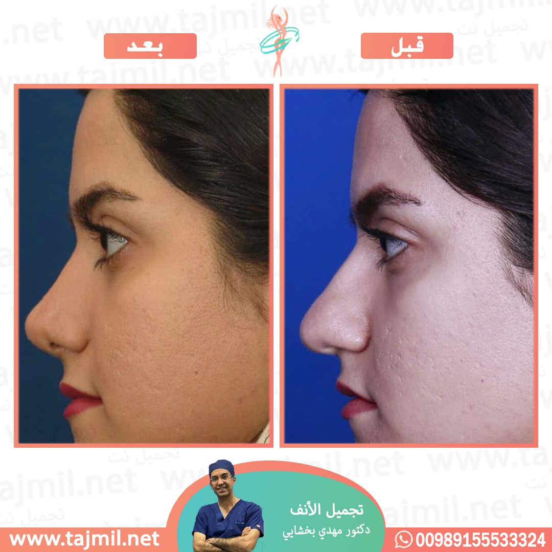  - دکتور مهدي بخشایي عملية تجميل الانف في ايران مع تجميل نت