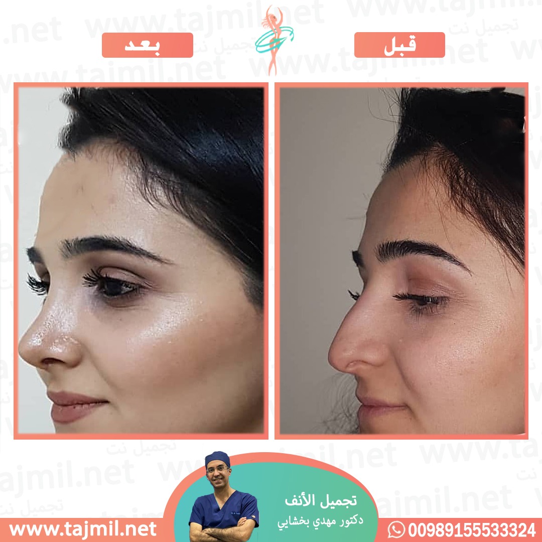  - دکتور مهدي بخشایي عملية تجميل الانف في ايران مع تجميل نت