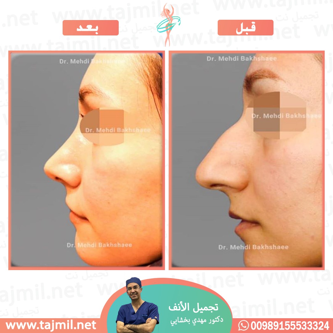  - دکتور مهدي بخشایي عملية تجميل الانف في ايران مع تجميل نت