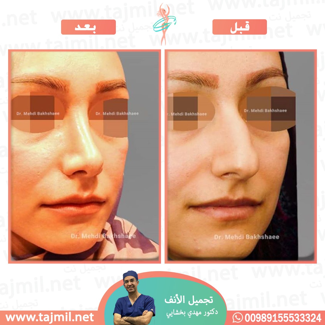  - دکتور مهدي بخشایي عملية تجميل الانف في ايران مع تجميل نت