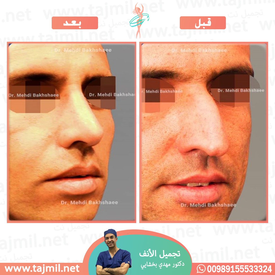  - دکتور مهدي بخشایي عملية تجميل الانف في ايران مع تجميل نت