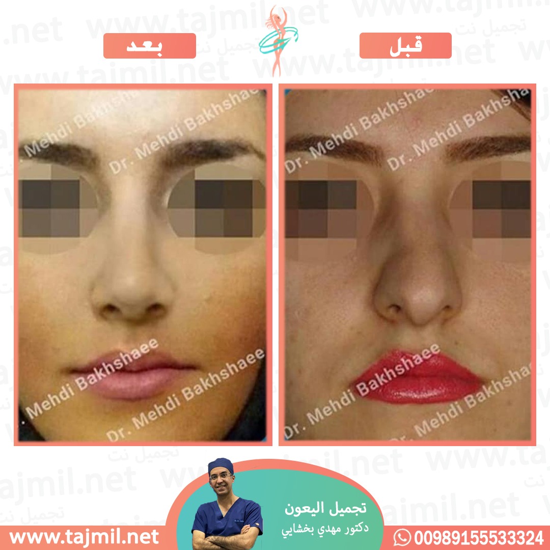  - دکتور مهدي بخشایي عملية تجميل الانف في ايران مع تجميل نت