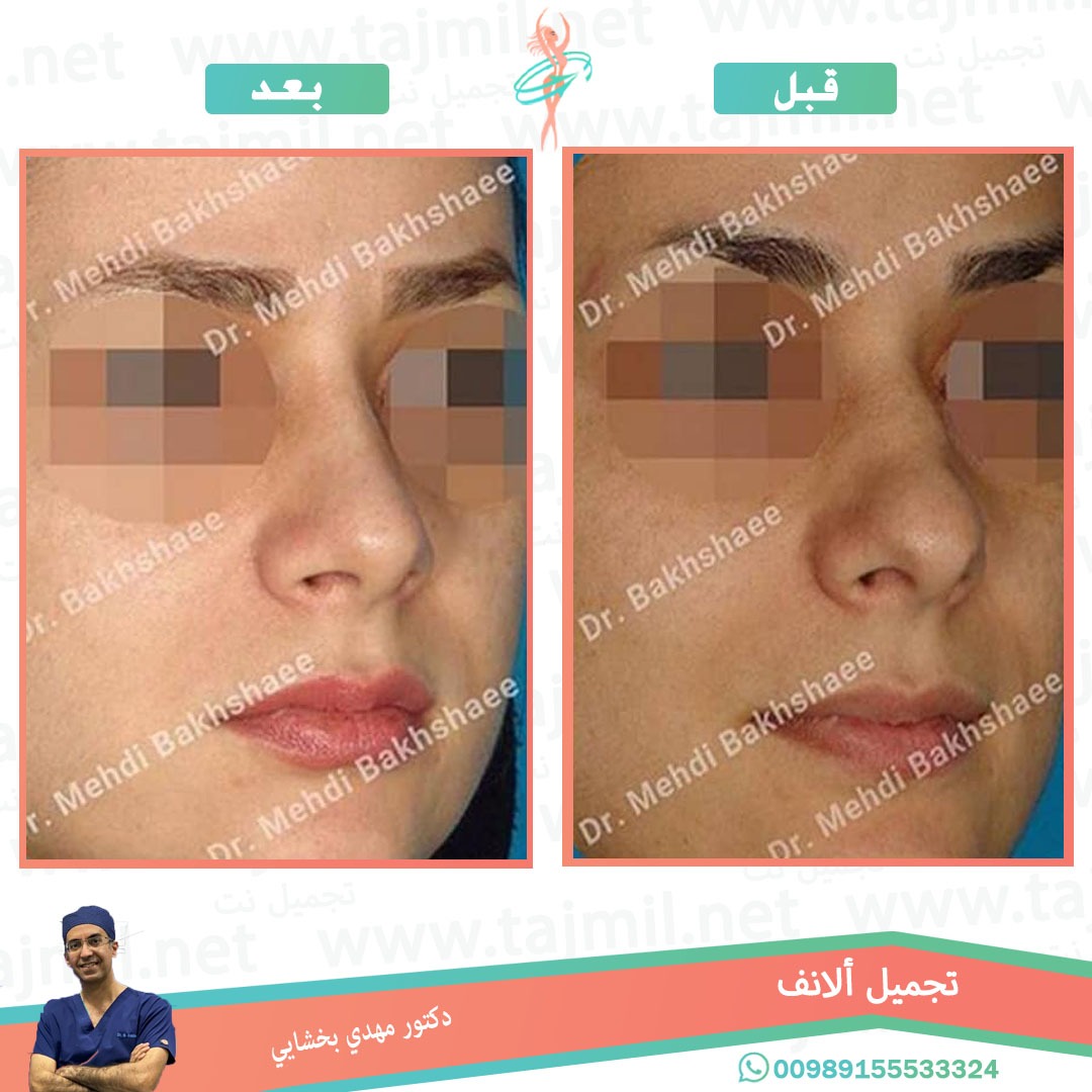  - دکتور مهدي بخشایي عملية تجميل الانف في ايران مع تجميل نت