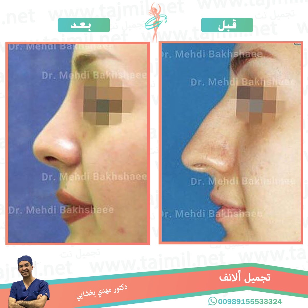  - دکتور مهدي بخشایي عملية تجميل الانف في ايران مع تجميل نت