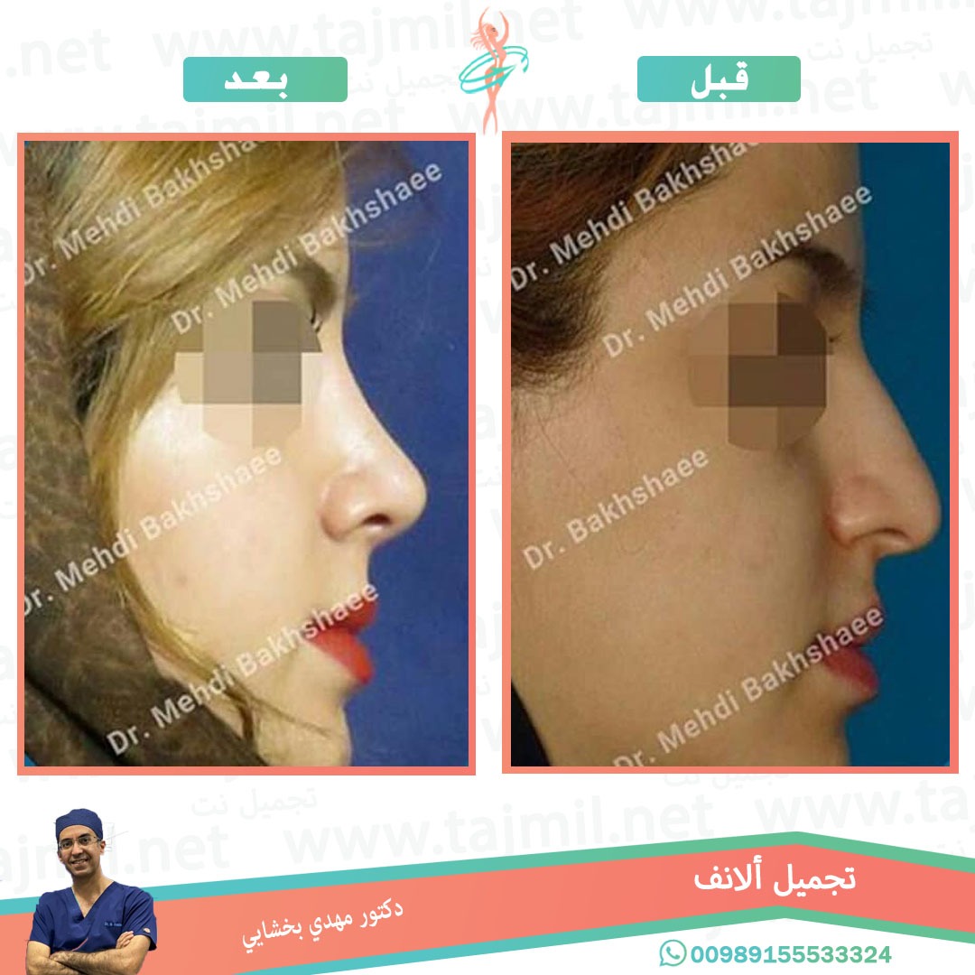  - دکتور مهدي بخشایي عملية تجميل الانف في ايران مع تجميل نت