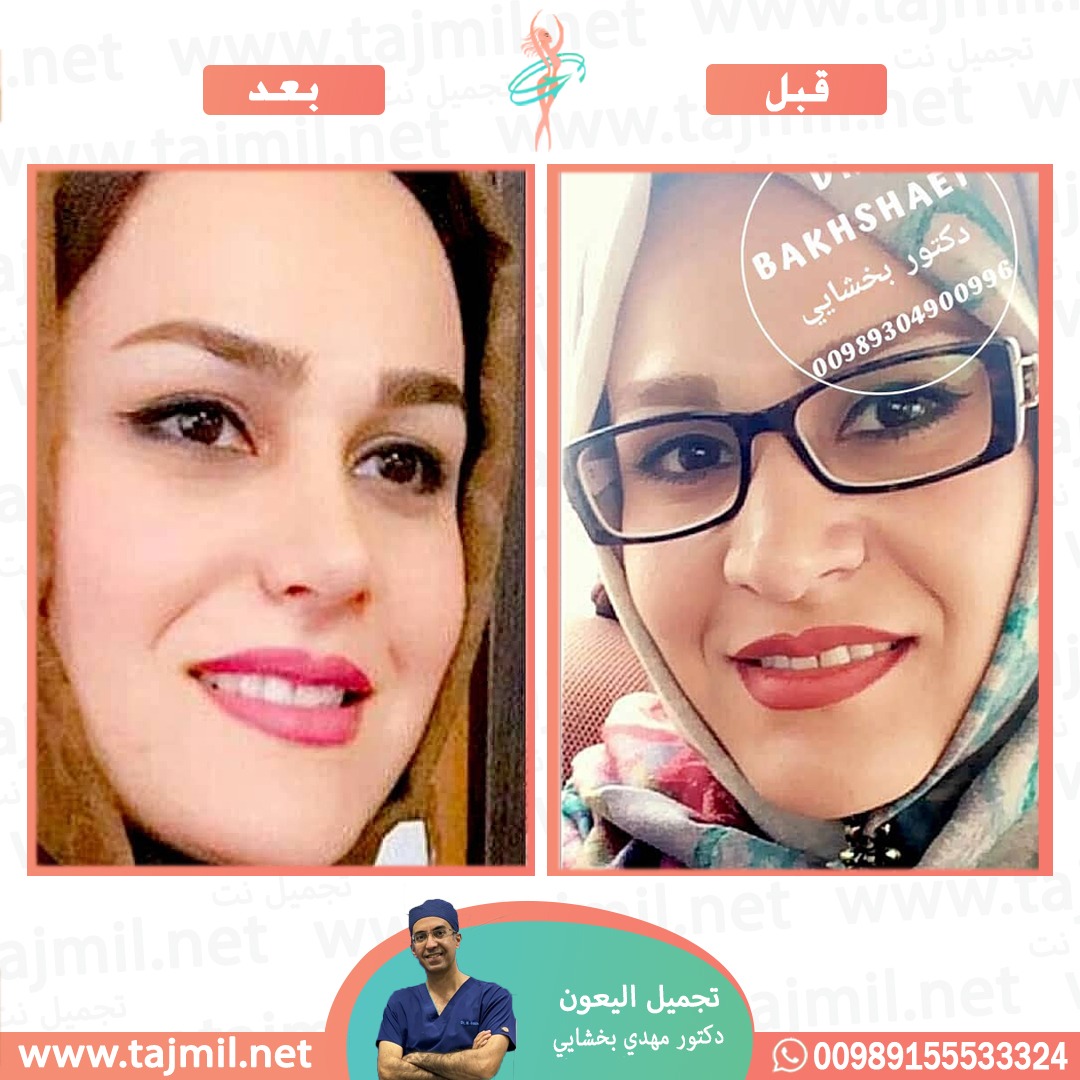  - دکتور مهدي بخشایي عملية تجميل الانف في ايران مع تجميل نت