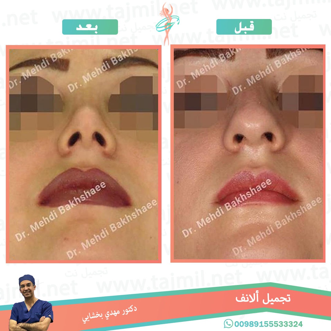  - دکتور مهدي بخشایي عملية تجميل الانف في ايران مع تجميل نت