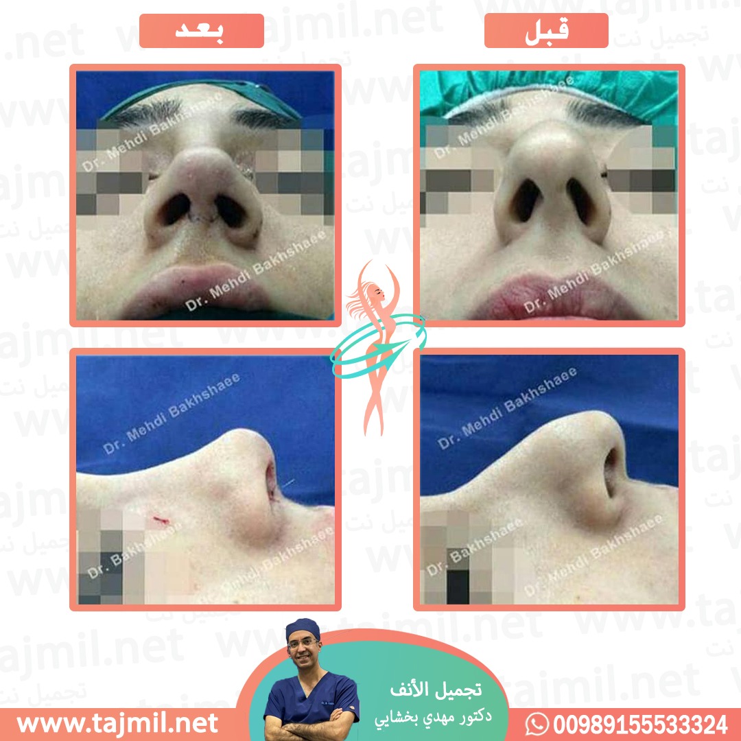  - دکتور مهدي بخشایي عملية تجميل الانف في ايران مع تجميل نت