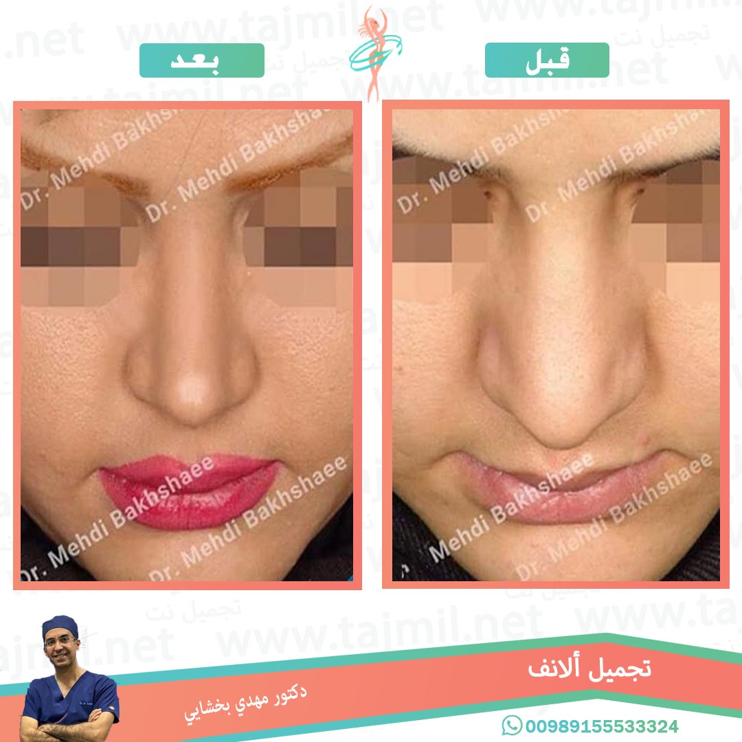  - دکتور مهدي بخشایي عملية تجميل الانف في ايران مع تجميل نت