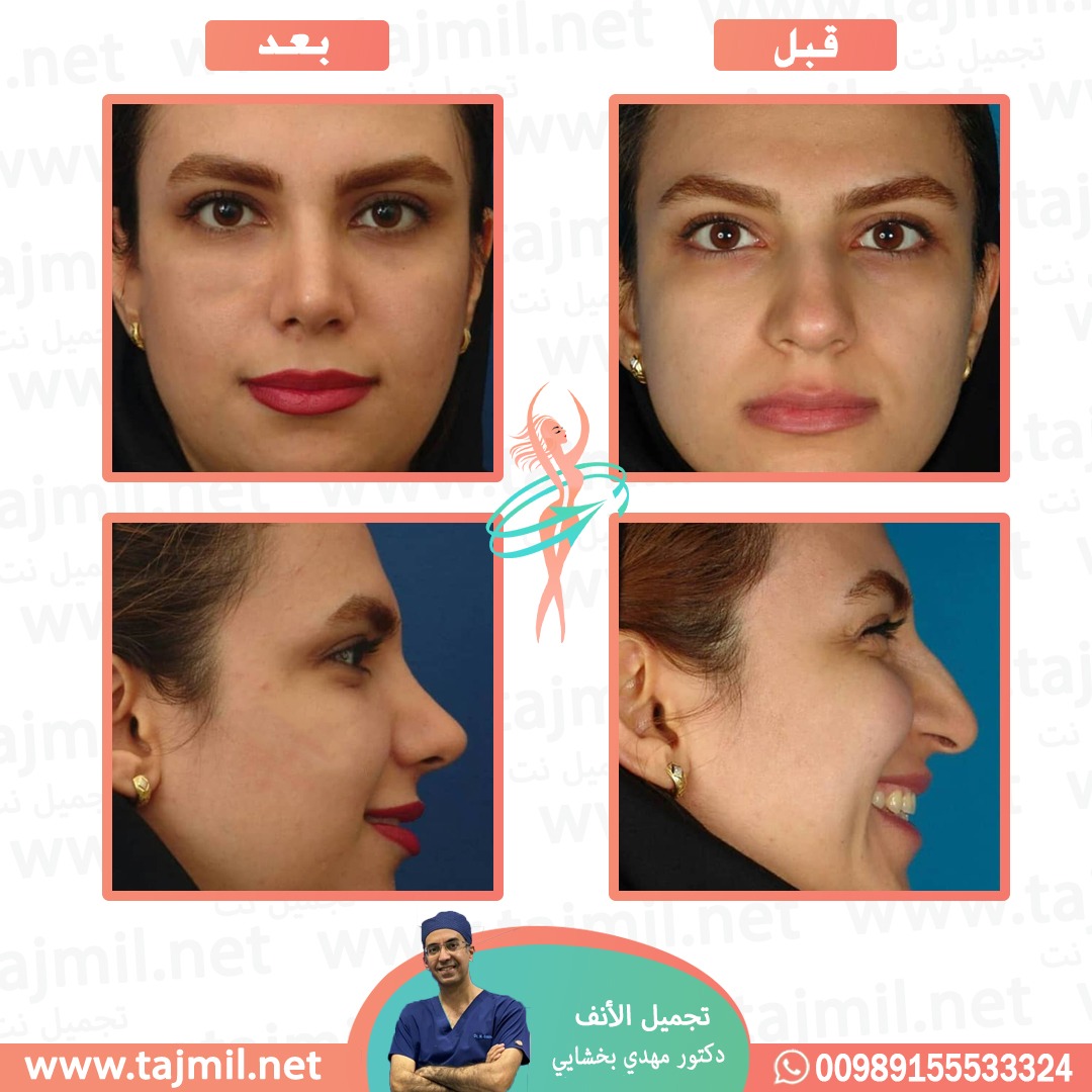  - دکتور مهدي بخشایي عملية تجميل الانف في ايران مع تجميل نت