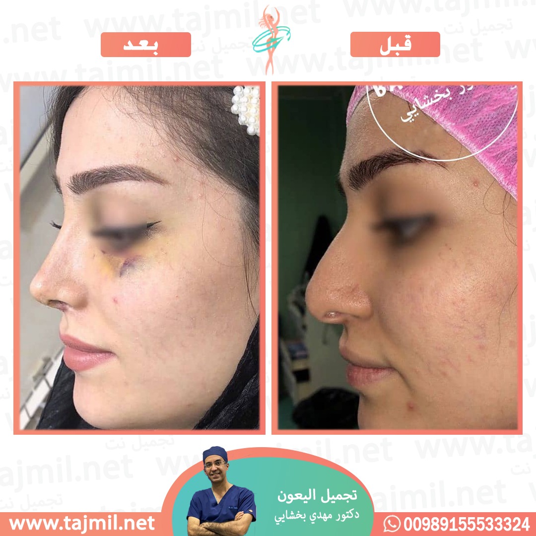  - دکتور مهدي بخشایي عملية تجميل الانف في ايران مع تجميل نت