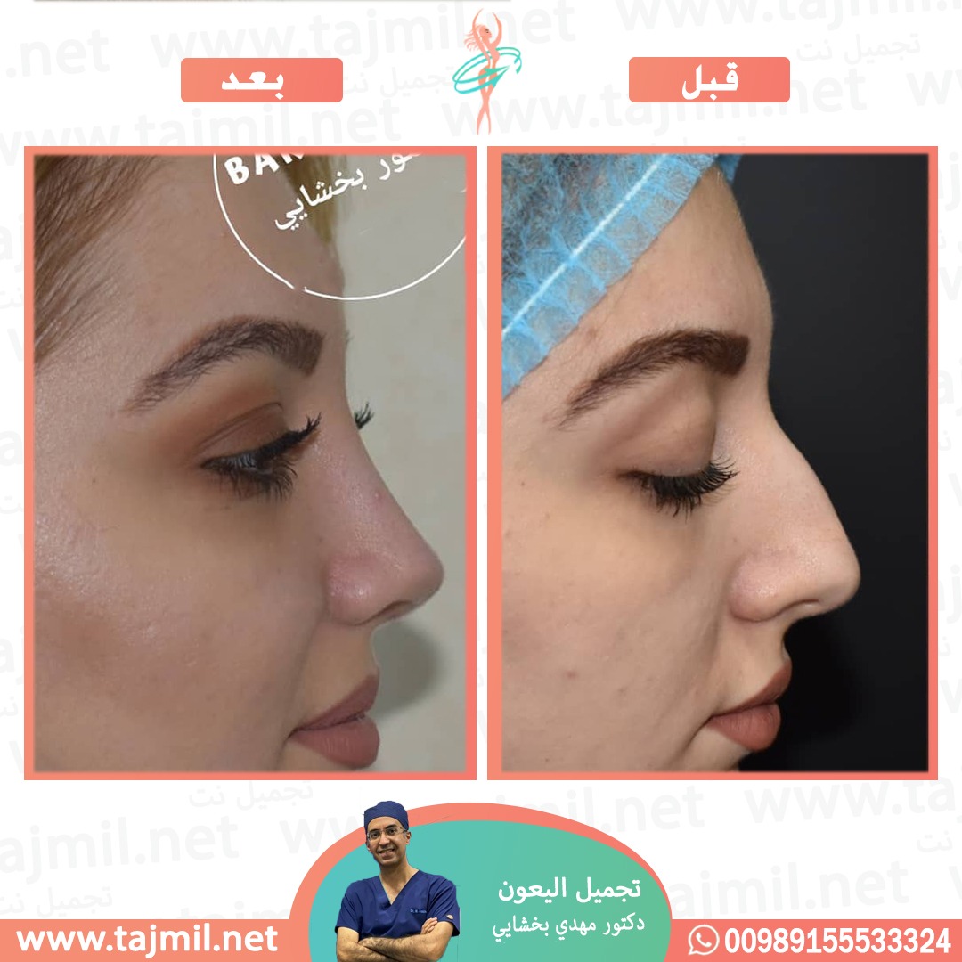  - دکتور مهدي بخشایي عملية تجميل الانف في ايران مع تجميل نت