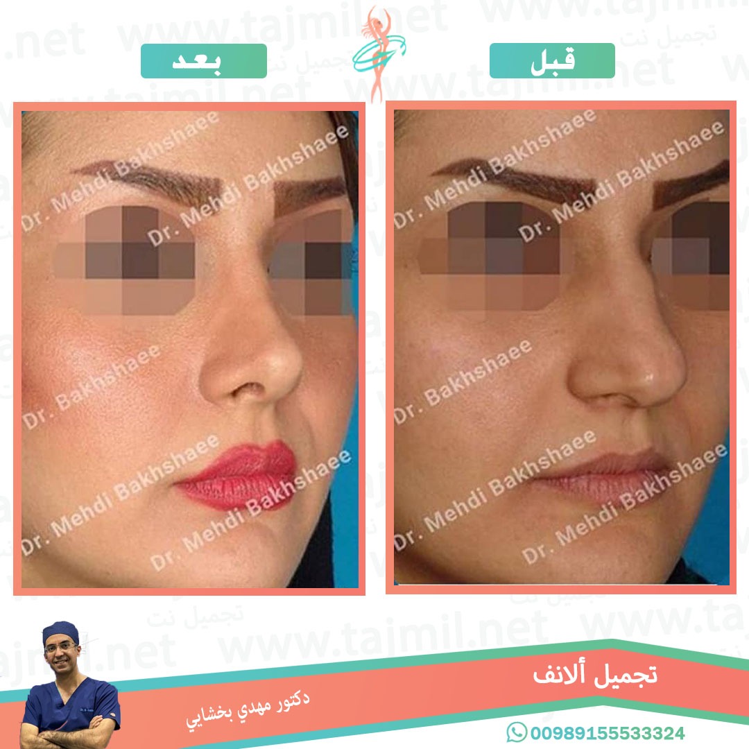  - دکتور مهدي بخشایي عملية تجميل الانف في ايران مع تجميل نت