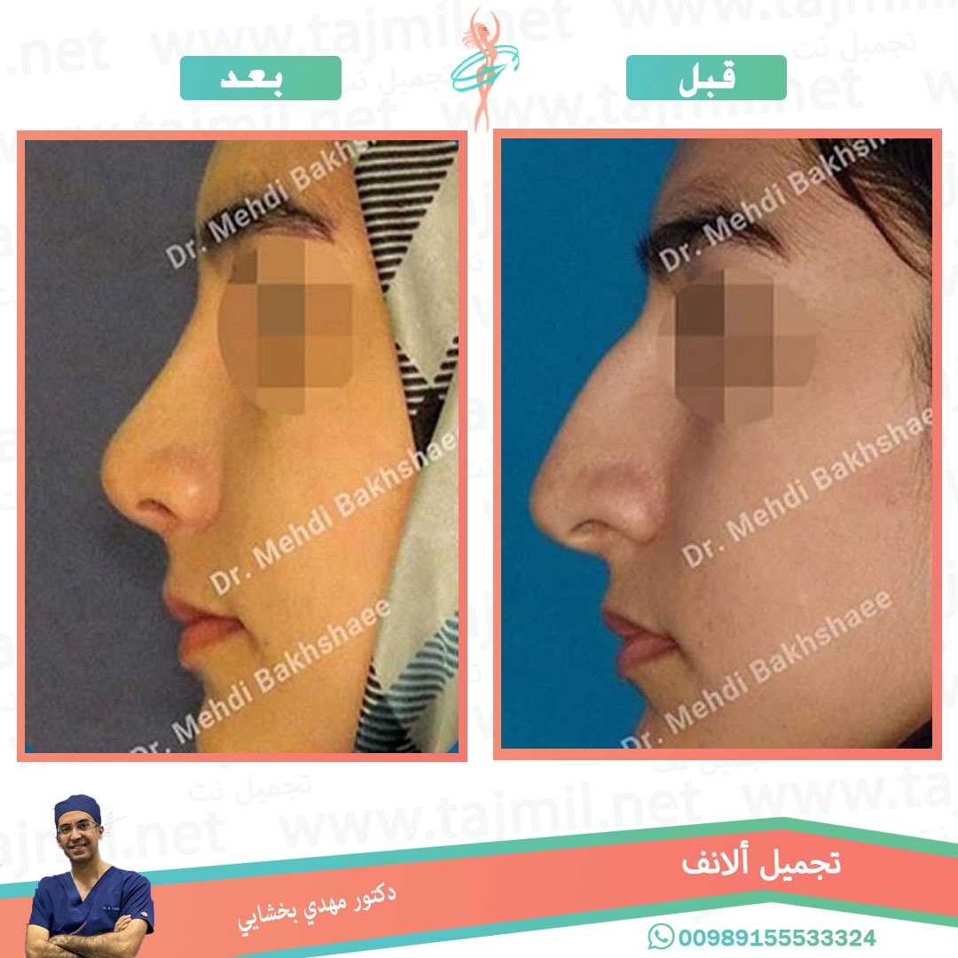  - دکتور مهدي بخشایي عملية تجميل الانف في ايران مع تجميل نت