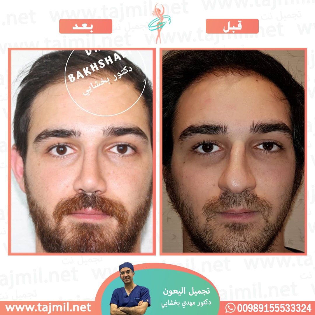  - دکتور مهدي بخشایي عملية تجميل الانف في ايران مع تجميل نت